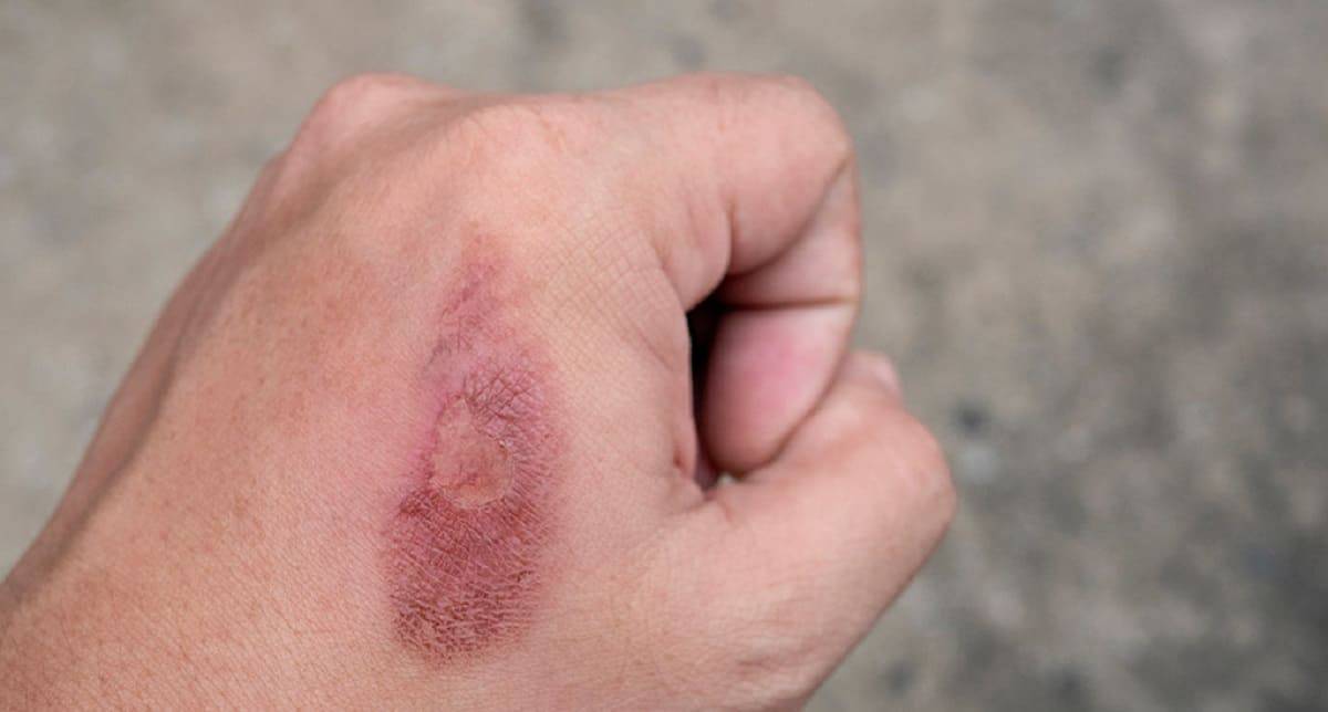 9 choses à avoir dans votre trousse de premiers soins pour traiter les brûlures